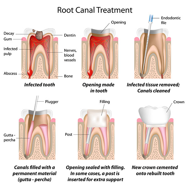 Root Canal Dentist